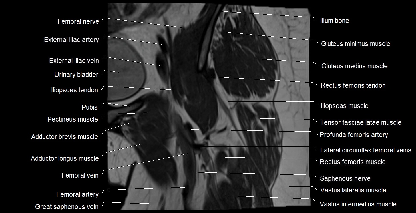 MRI Hip 3T coronal cross sectional anatomy image 16.webp